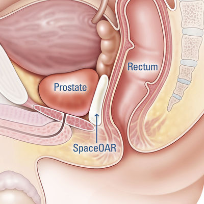 You're diagnosed with prostate cancer - so what's next?